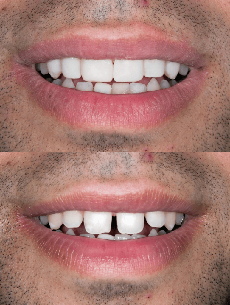 Turkye Tandheelkundige Veneers Voor - Na