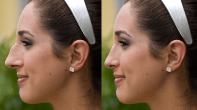 Rhinoplasty Iran vs Qaib ntxhw