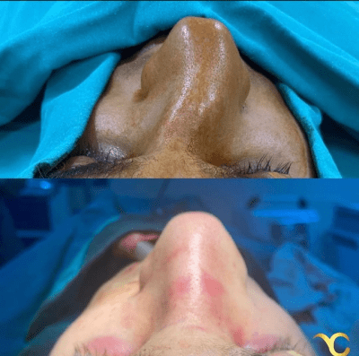 Rhinoplasty Iran vs Qaib ntxhw