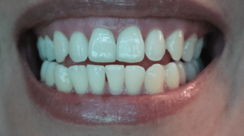 Hollywood Smile Cost i Brasil