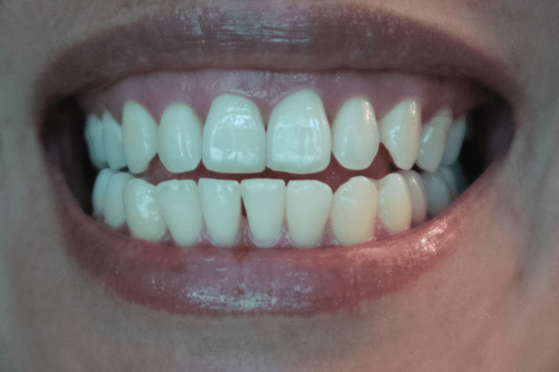 Hollywood Smile Cost in Brasile