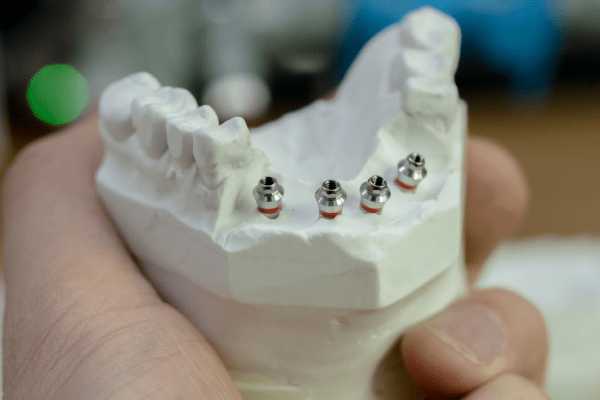 Dental Implants