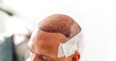 Hair Transplantare possum, si Grey Hair? The Guide to Ageless Hair Restoration