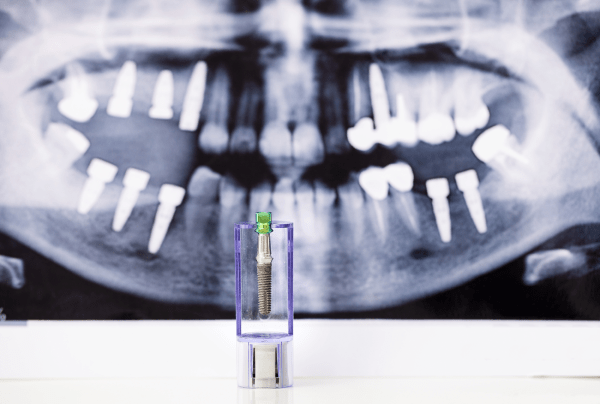 Recuperació de l'empelt ossi d'implant dental El que necessiteu saber