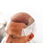 Hair Transplant Cyprus Turkish Side The Ultimate Guide