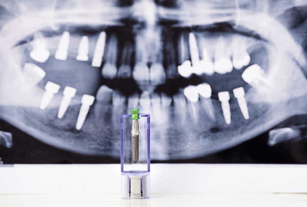 Monténégro Dental Implant Kontra Pro jeung Biaya