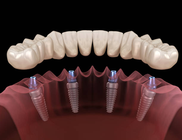 Gruziyadagi tish implantlari