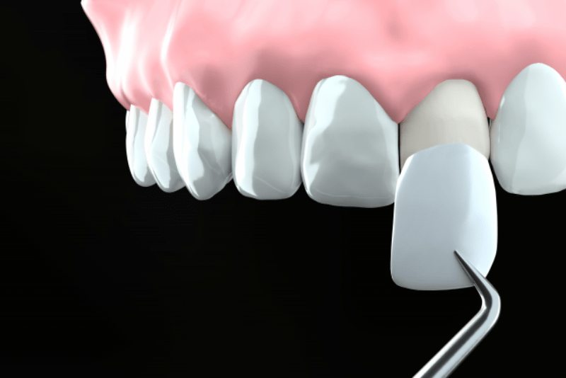 ʻO Zirconium Veneers ma Kanada