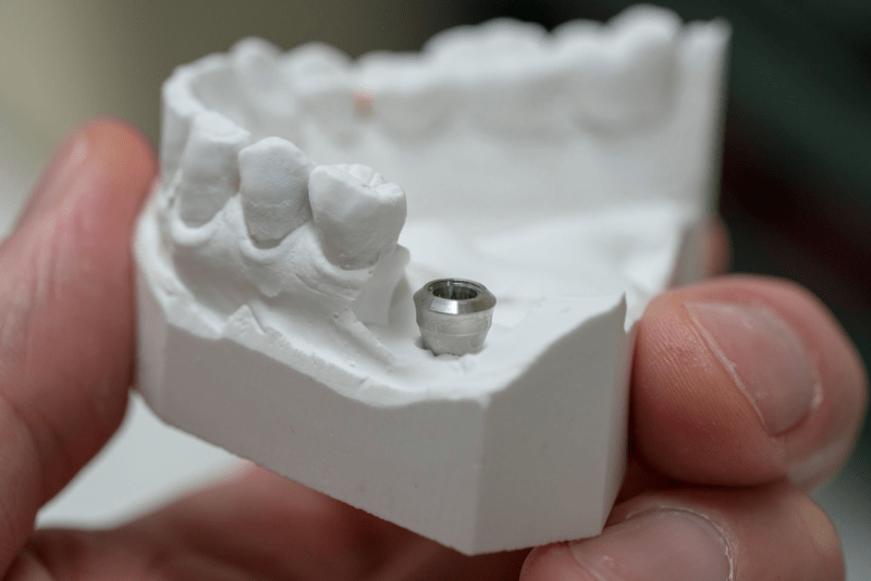 Dental Implant Risks