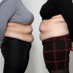 Gastrik Bypass Cerrahisi