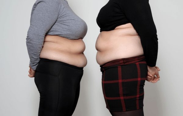 Gastric Bypass Surgery