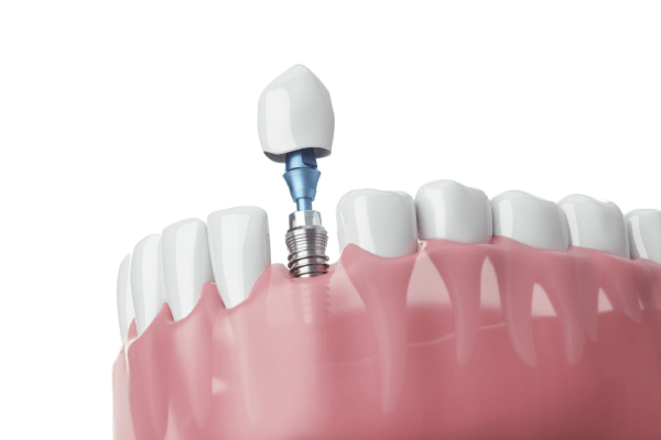 Dental Implants in Cyprus
