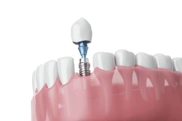 Cheap Dental Implants in Cyprus: Near and High-Quality Dental Care 2 Dental Implants in Cyprus