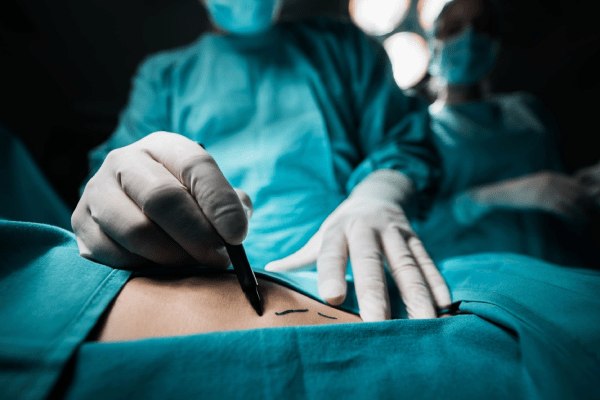 Izindleko ze-Liposuction e-Istanbul