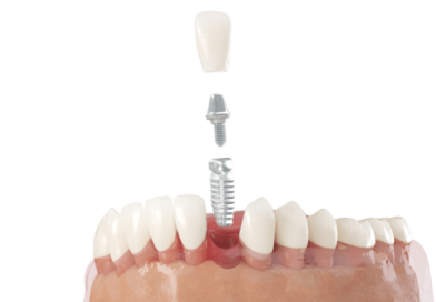 Dental Implant in Turkey