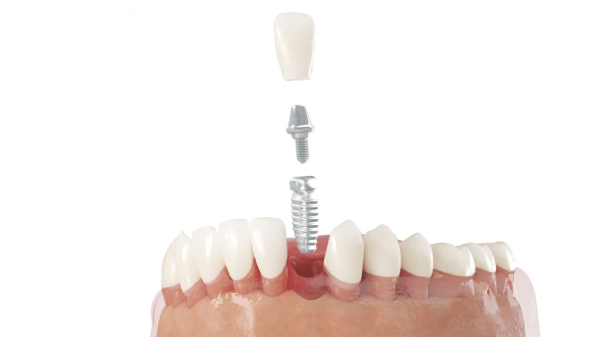 Dental Implant sa Turkey