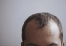Hårtransplantation i Istanbul