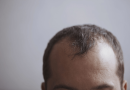 Hair Transplant in Istanbul