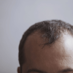 Hair Transplant in Istanbul