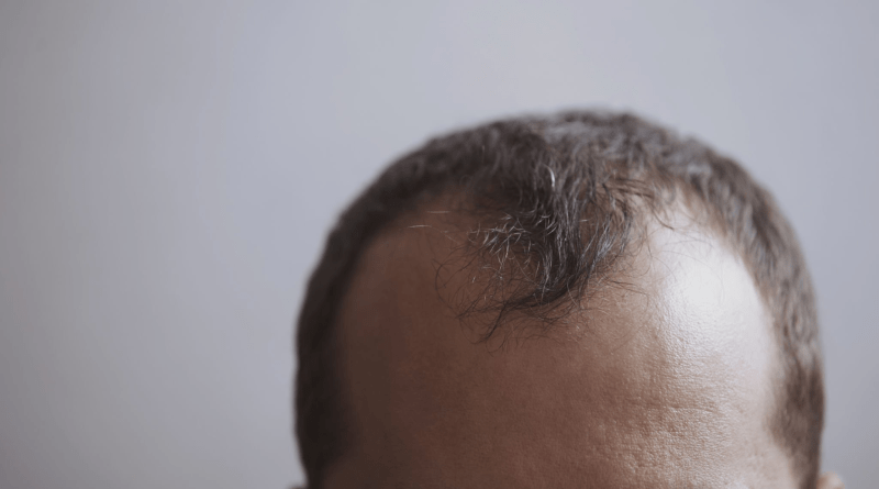 Hårtransplantation i Istanbul