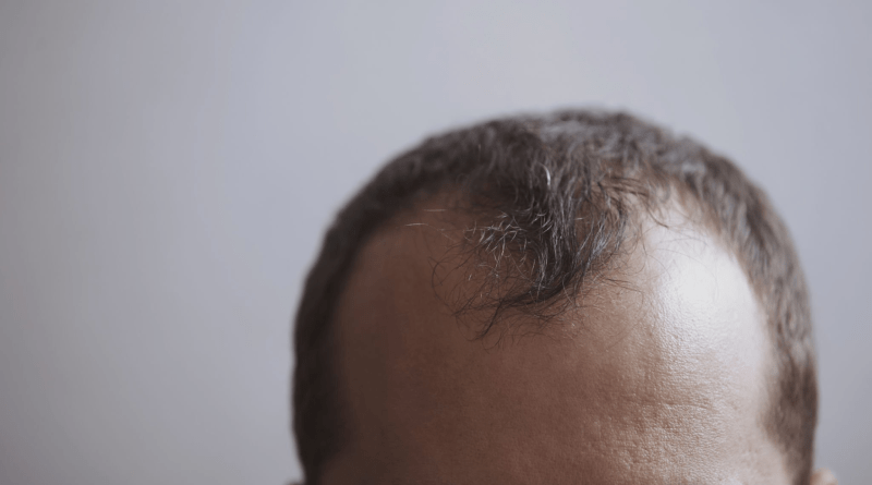 Hair Transplant in Istanbul