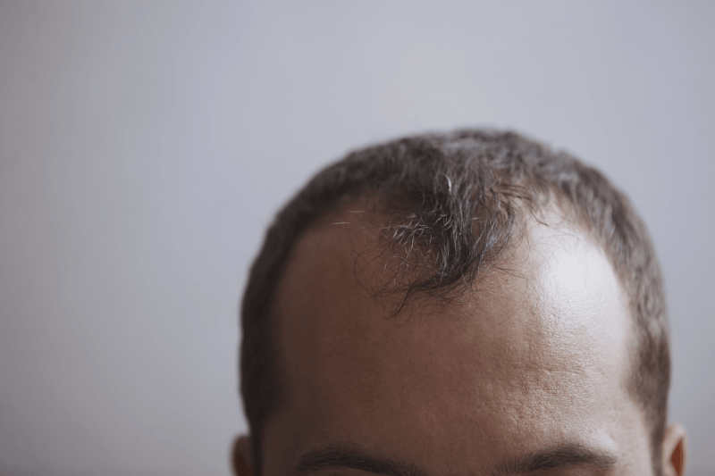 Трансплантација на коса во Истанбул