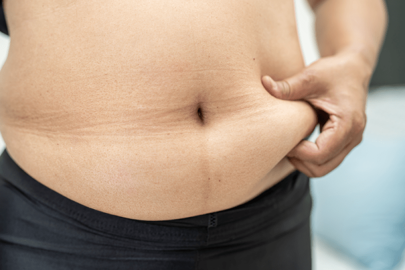 Kusadasi Gastric Sleeve Surgery