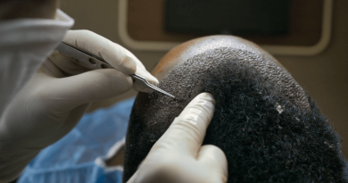 Hårtransplantation i Istanbul