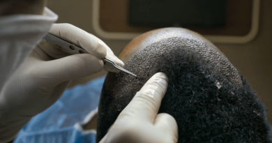 Hair Transplant in Istanbul