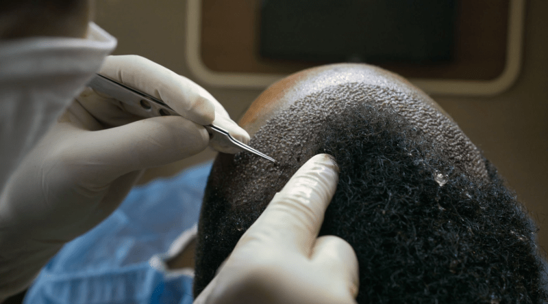 Hårtransplantation i Istanbul