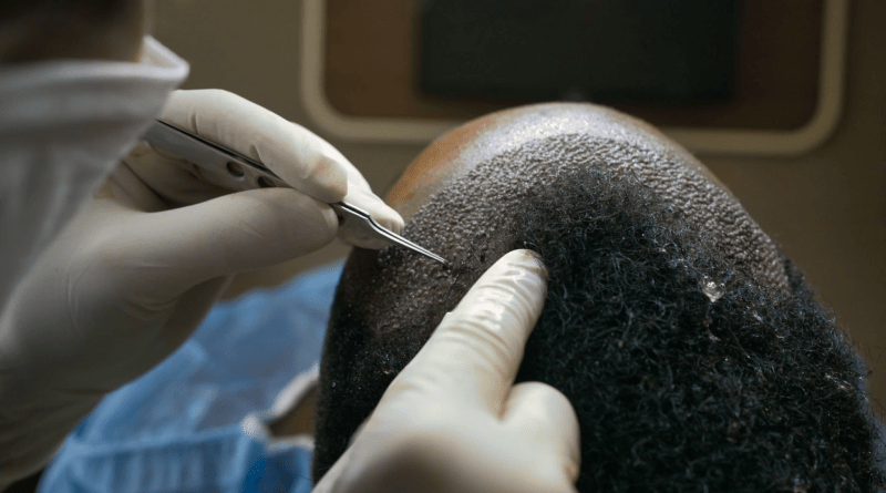 زراعة الشعر في اسطنبول