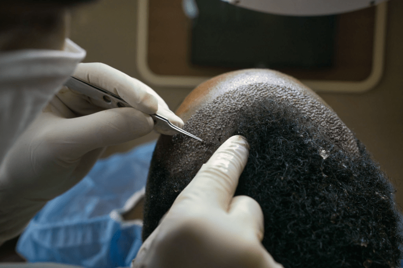 Hair Transplant in Istanbul