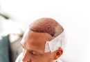 Hair Transplant in Istanbul