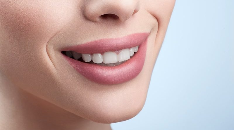 Veneers porselen di Kosovo